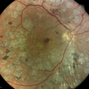 Diabetická retinopatia